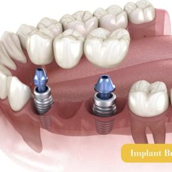 implant bridge