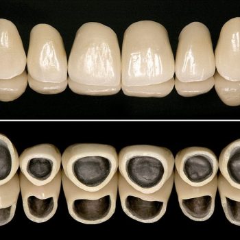 metal destekli porselen
