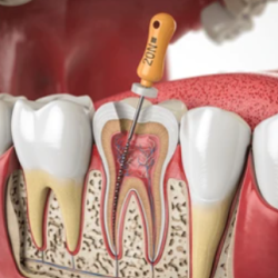 root canal